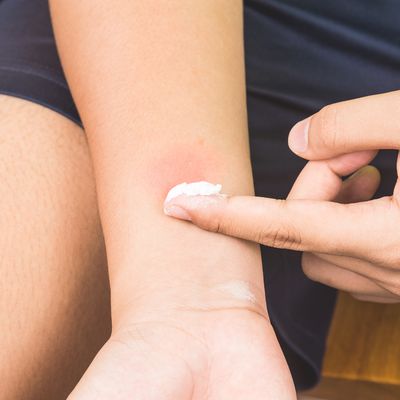 How To Deal With Insect Bites & Stings This Summer