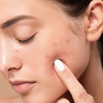 9 Ways You’re Making Your Breakouts Worse