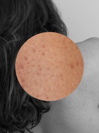The Tips, Treatments & Best Products For Treating Keratosis Pilaris