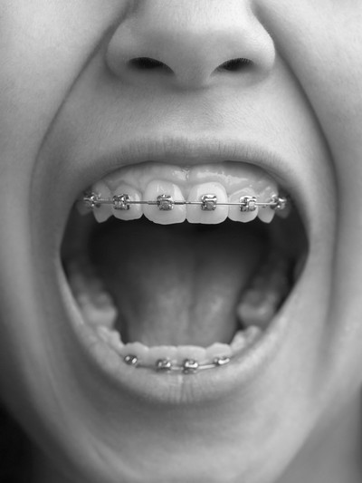 Everything Parents Should Know About Children’s Braces