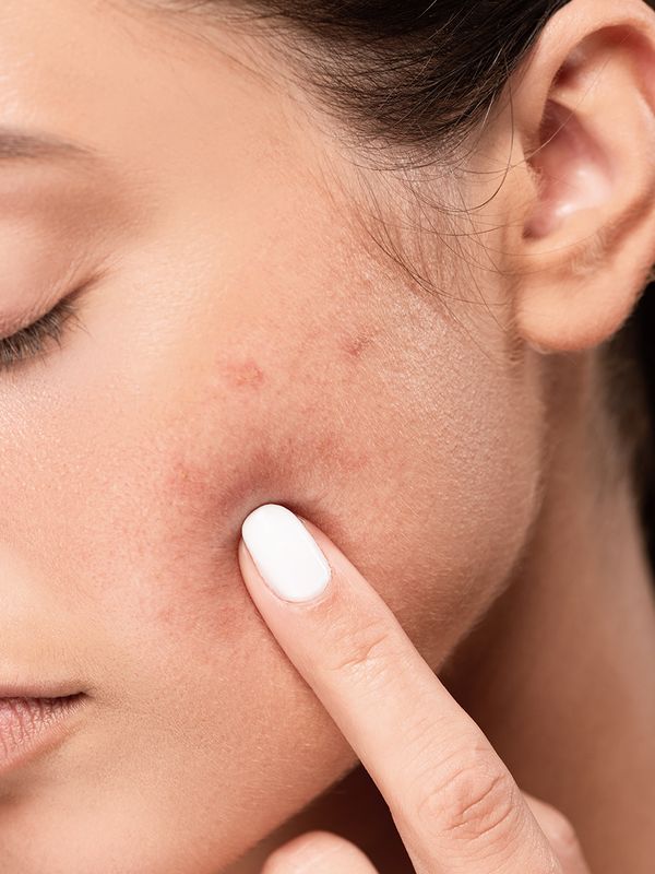 9 Ways You’re Making Your Breakouts Worse