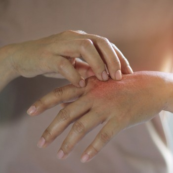 Eczema 101: From Triggers To Treatment