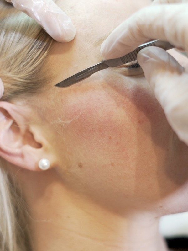 Extreme Beauty: Dermaplaning