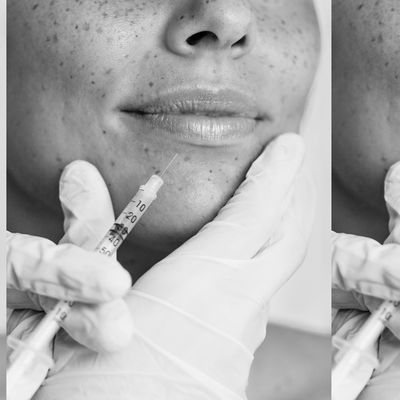 A Comprehensive & Honest Guide To Lip Filler