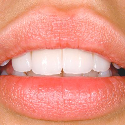 Everything You Need To Know About Veneers