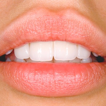 Everything You Need To Know About Veneers