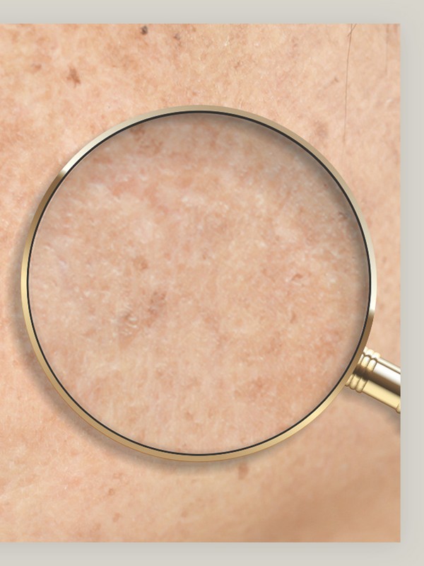 Dark Spots: What They Are, Why They Occur & How To Treat Them 