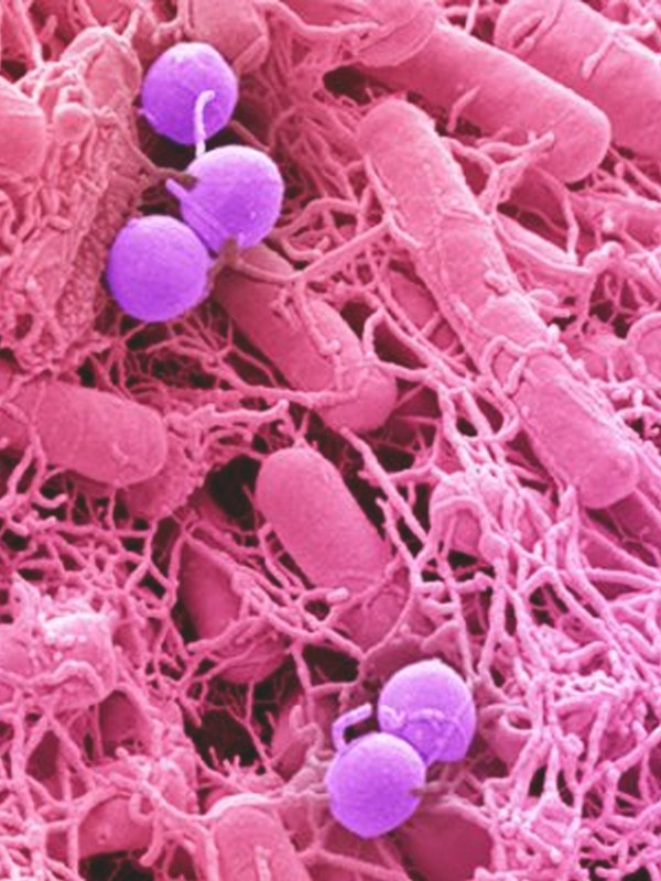 What You Need To Know About Bowel Cancer