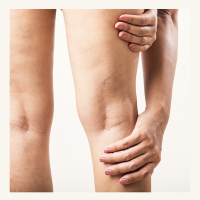 Home Test for Varicose Veins – The Whiteley Clinic