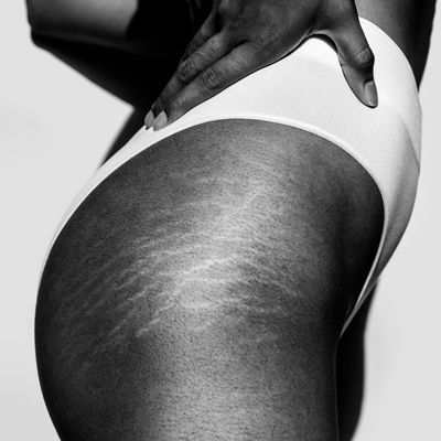 Beauty 101: What You Need To Know About Stretchmarks