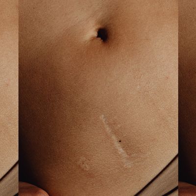 A Complete Guide To Treating Scars 