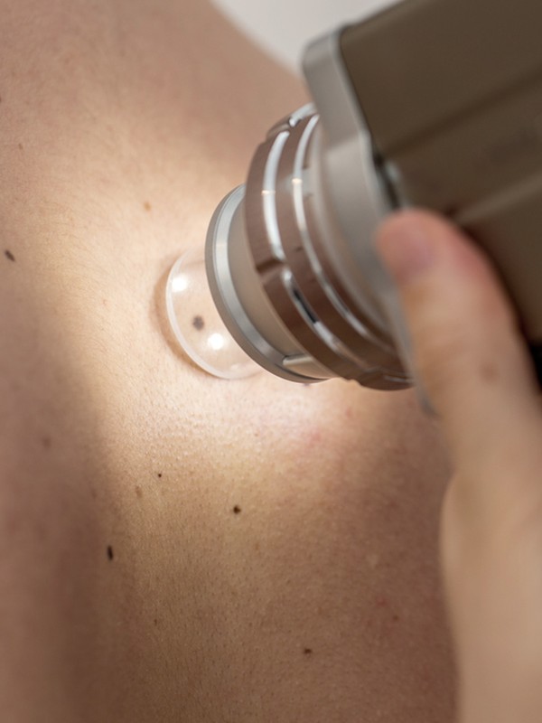 A Guide To Checking Your Skin Post Summer