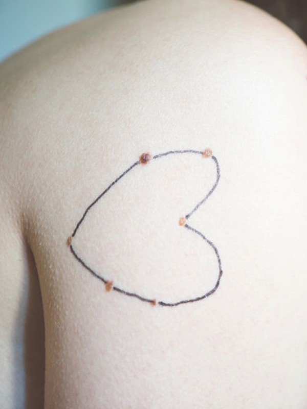 Everything You’ve Ever Wanted To Know About Your Moles