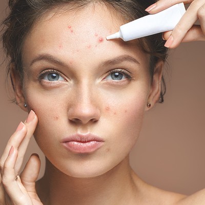 Everything You Need To Know About Adult Acne