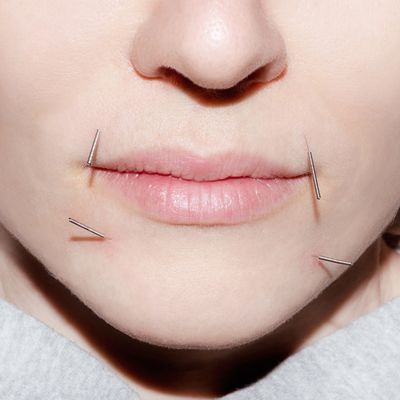 What You Need To Know About Acupuncture