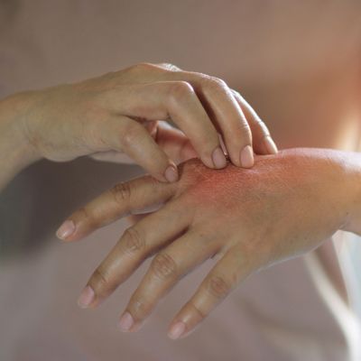 Eczema 101: From Triggers To Treatment