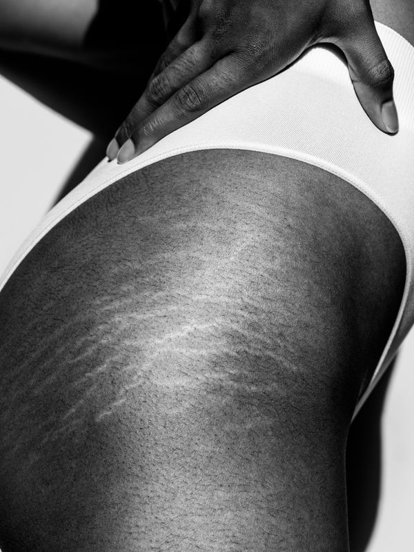 Beauty 101: What You Need To Know About Stretchmarks