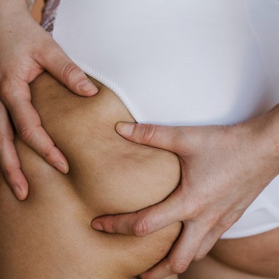 A Comprehensive & Honest Guide To Cellulite