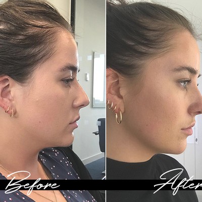 Here’s Why You Should Consider A Non-Surgical Nose Job 