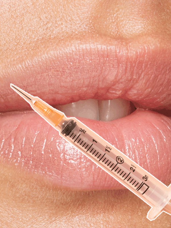 Lip Fillers: What You Should Know Before Having Them
