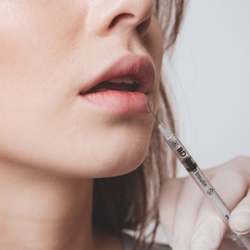 What It's Like To Have Lip Fillers Removed