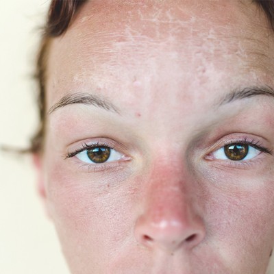 Sun Damage: How To Treat It 