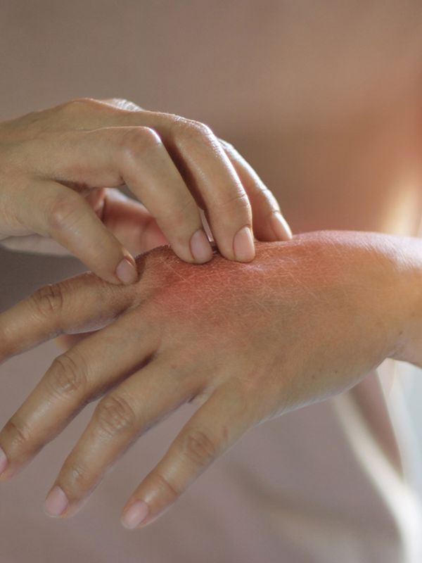 Eczema 101: From Triggers To Treatment