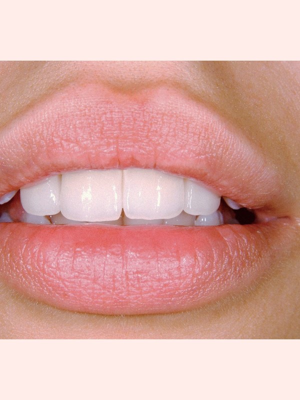 Dental Bonding: Why It’s So Popular