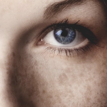 9 Things You Need To Know About Melasma