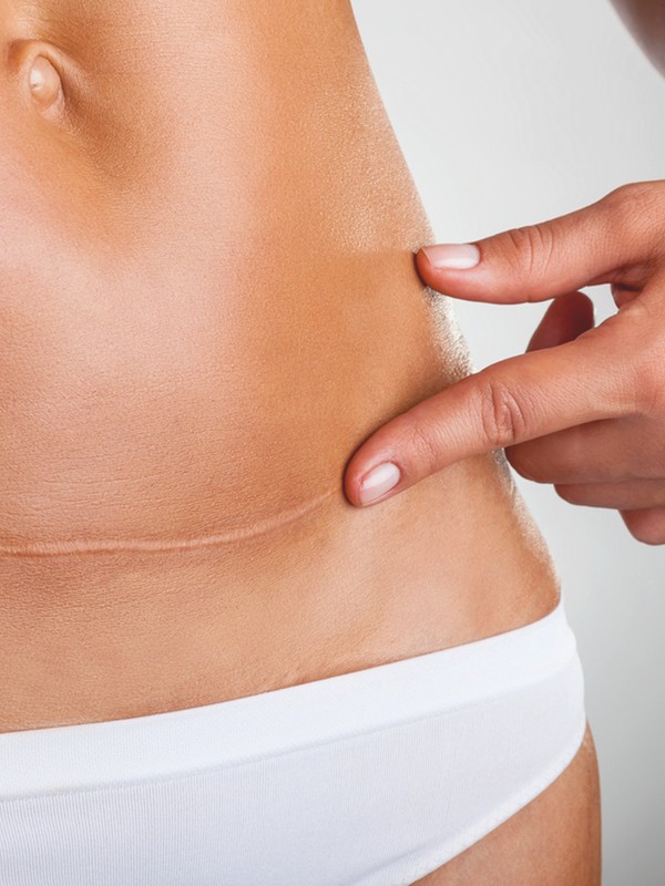 How To Treat Different Scarring, According To A Skincare Expert