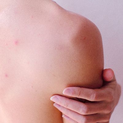 Back Acne: How To Treat & Prevent It 