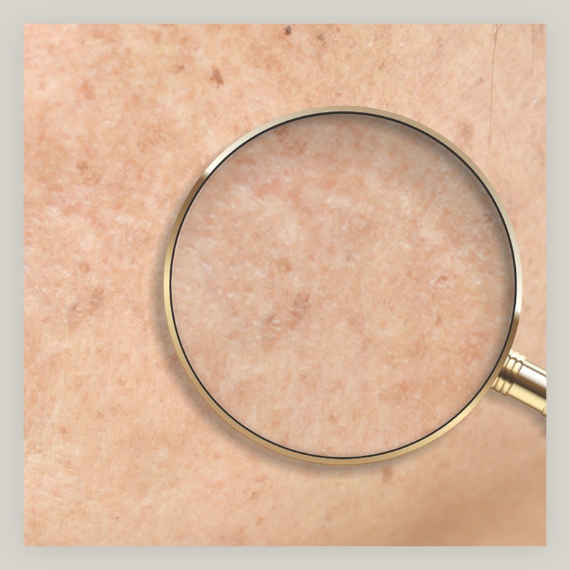 Dark Spots: What They Are, Why They Occur & How To Treat Them