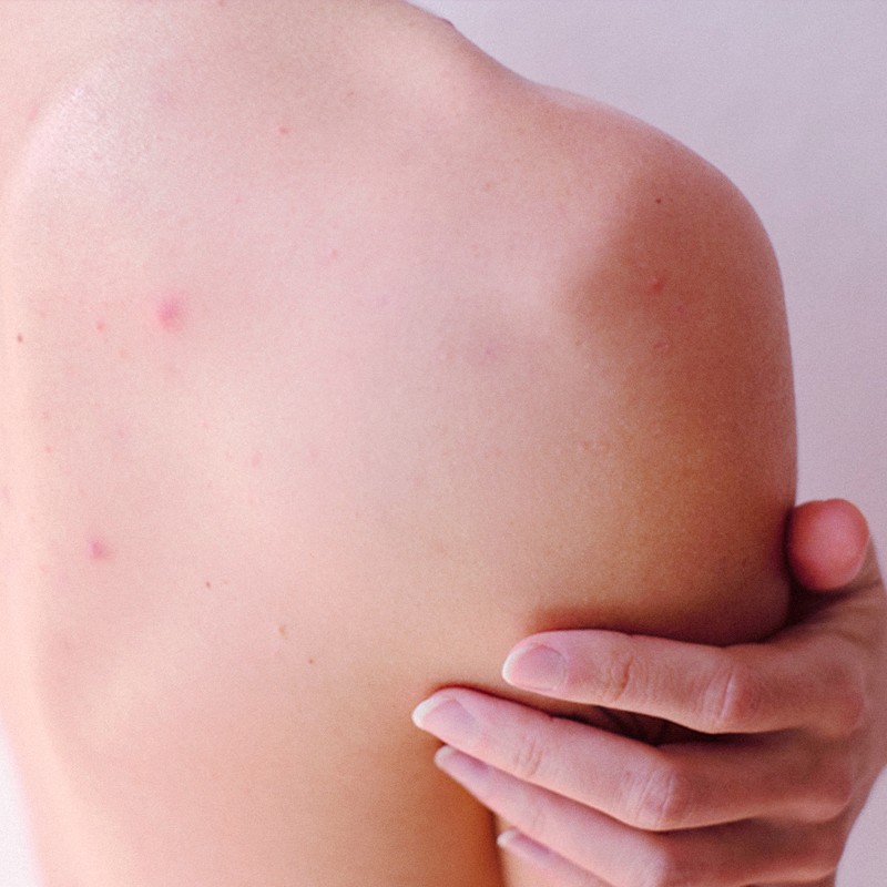 Back Acne: How To Treat & Prevent It 