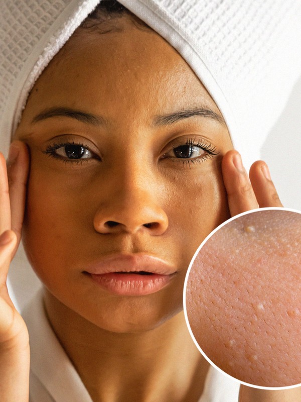 Milia: What They Are & How To Get Rid Of Them
